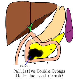 double bypass
